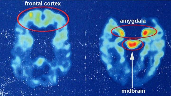 What is CTE? NYC shooting suspect Shane Tamura claims to suffer from CTE linked to football injuries