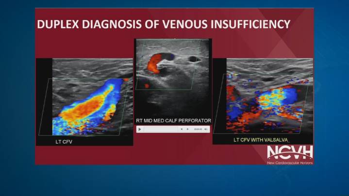 Could you have the same vein condition just diagnosed for President Trump? See what experts say