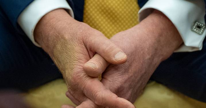 What is chronic venous insufficiency and how will it affect Trump?