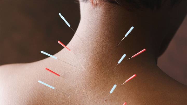 Beneficios de la acupuntura que no conocías (desde alivio del estrés hasta dolor muscular)