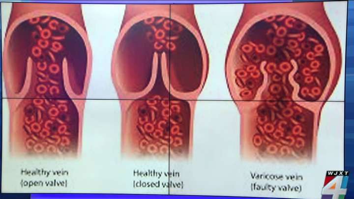 Heart & vascular expert explains President Trump’s ‘chronic venous insufficiency’