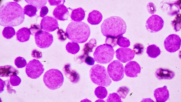 Novel Combo Boosts Survival in IDH1