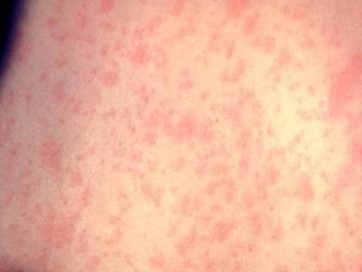 Measles cases in the U.S. reach highest levels in 33 years, CDC reports