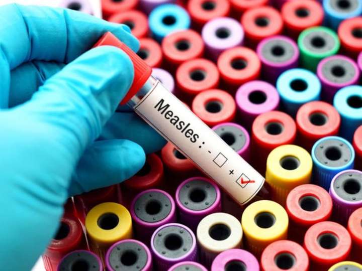 N.J. reports latest measles exposure as nationwide cases hit record high