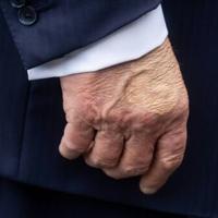 Trump diagnosed with vein issue after leg swelling and hand bruising