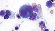 Blood Cell Patterns Predict Poor Venetoclax Response