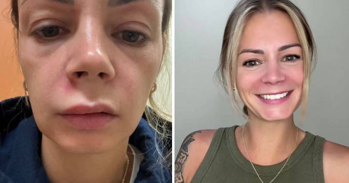 Woman, 32, rushed to hospital after popping pimple on her 'triangle of death'