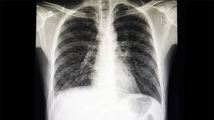 IBD Linked to Higher Risk for Interstitial Lung Disease