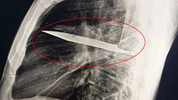 Man complains of sore nipple only for docs to find giant KNIFE had been lodged in his chest for eight years
