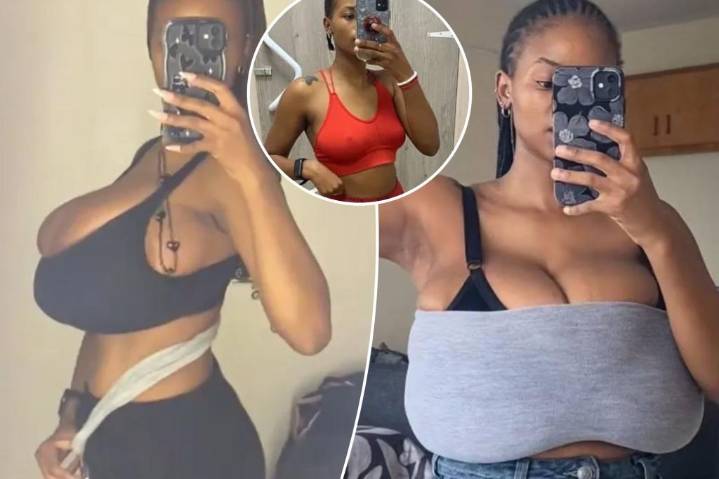 My 32A chest grew to a 34G in a matter of months due to rare condition