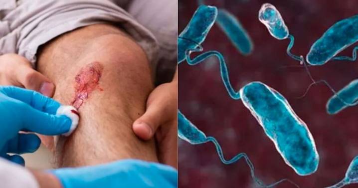 Alerta médica: qué es la fascitis necrosante (virus come carne) y cómo identificarla a tiempo
