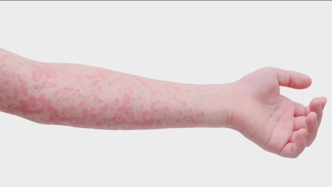 Bonneville County child contracts region's first measles case since 1991