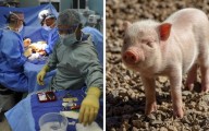 China realiza el primer trasplante de pulmón de cerdo a humano en muerte cerebral