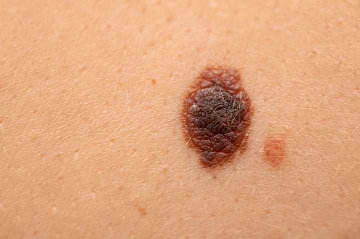 Cancer Vaccine Misses Mark in Phase 3 Advanced Melanoma Trial