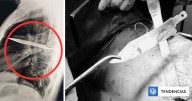 Tanzania: hombre fue al médico por pus que salía de su pecho y descubrió cuchillo enterrado hace años