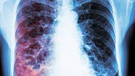 Mueren 12 a causa de la tuberculosis en Nuevo Laredo