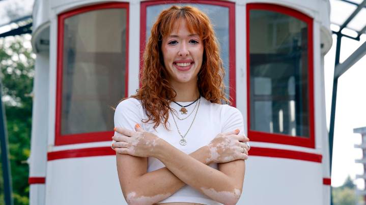 El relato de Carla García sobre su vitíligo: «Hoy lo poco común se hace atractivo, entonces se está explotando»