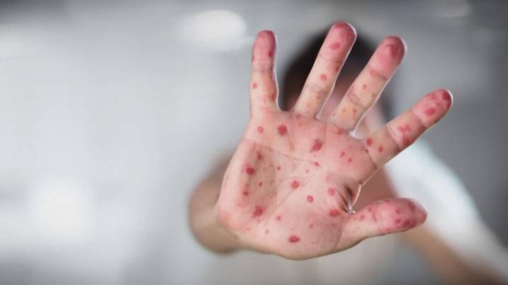 Kootenai County child contracts region's first measles case in 30 years
