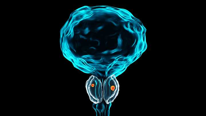 Low-Grade Prostate Cancer Not Always Low Risk