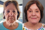 Woman, 78, Goes Viral for Shocking Facelift Results: Inside Her Transformation (Exclusive)