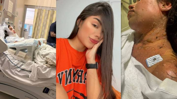 Bartender colombiana sufrió graves quemaduras durante espectáculo de fuego en Estados Unidos: “nadie la auxiliaba”