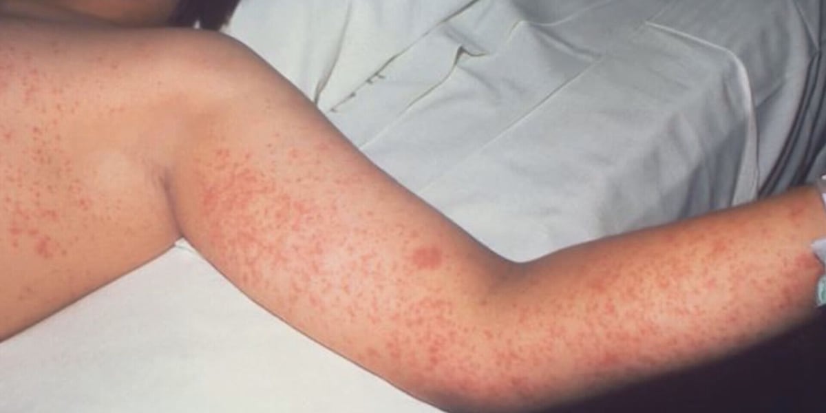 Measles virus detected at wastewater sampling site