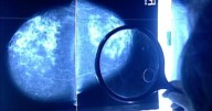 Research finds AI tools may support mental health needs of breast cancer patients