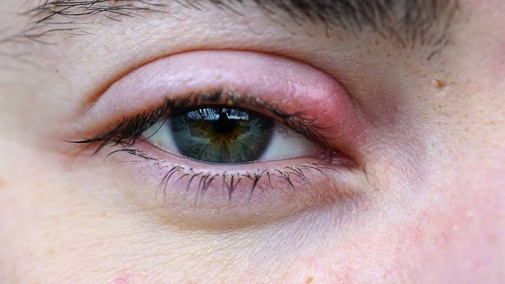 Qué significa cuando nos aparece un orzuelo en el ojo y a qué se debe