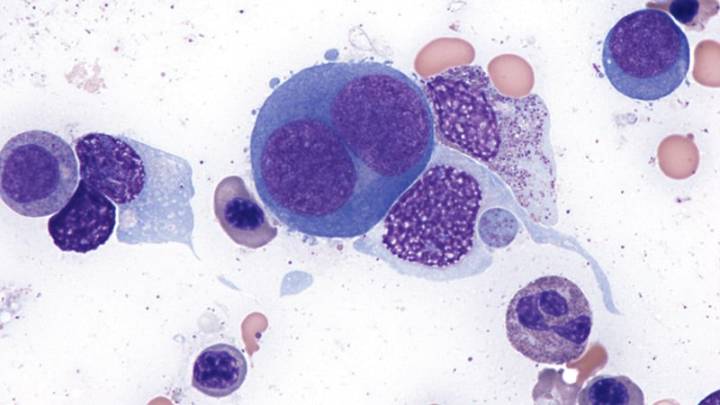 Blood Cell Patterns Predict Poor Venetoclax Response
