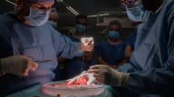 Realizado el primer trasplante de pulmón de cerdo a un humano en muerte cerebral