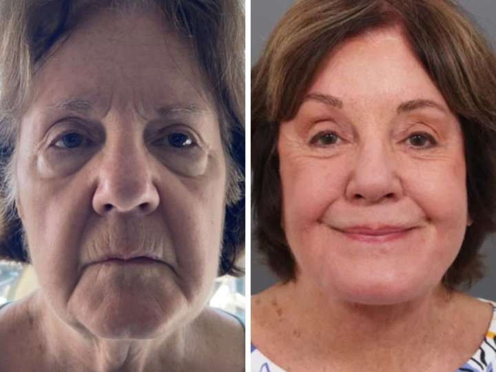 Una mujer de 78 años mostró imágenes de su rejuvenecimiento facial y captó la atención de miles de personas