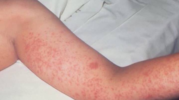 Texas health officials officially declare end of West Texas measles outbreak