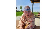 Walk to build community for people with alopecia areata
