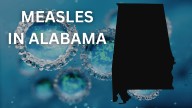 Alabama confirms first measles case since 2002 in unvaccinated child
