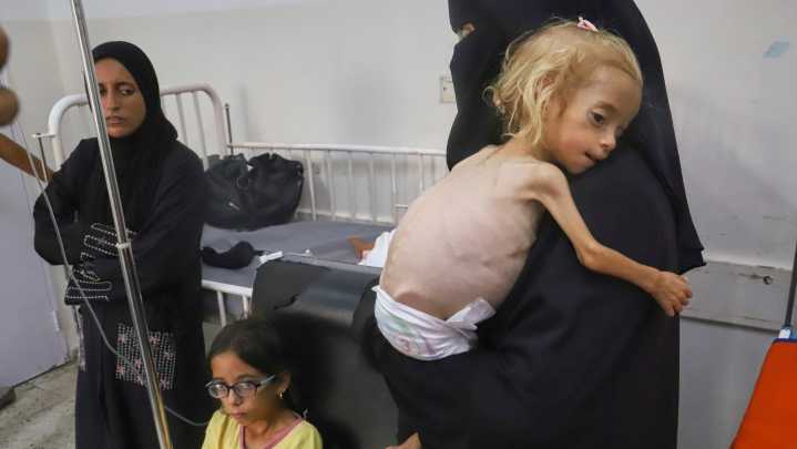 Doctors in Gaza say patients' protruding ribs, bony limbs evidence of malnutrition