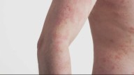 Hampton Roads' high humidity can worsen psoriasis, but sunlight helps