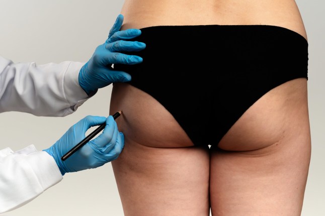 Brazilian butt crackdown begins in fight against cosmetic procedure ‘Wild West’