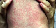 More measles cases confirmed in Oconto County