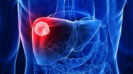 Advanced HCC: Which First-line Treatment Is Best?