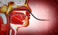 Skipping Nasogastric Tubes After Esophageal Surgery May Raise Leak Risk