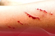 Fallece hombre en Colima por rabia humana