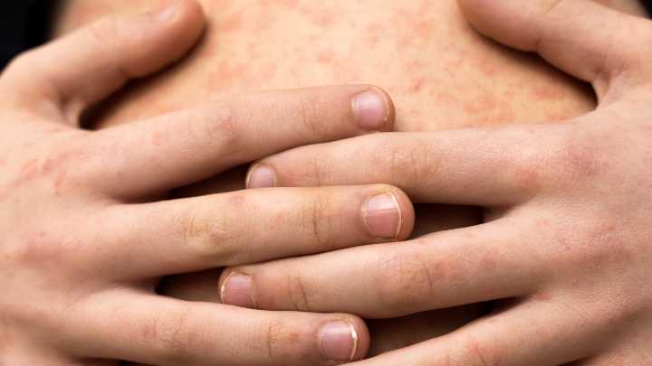 Casos de sarampión suman más de 4 mil en México