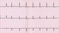 Evidence-Based Guidelines Issued for LAAO Devices