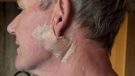 Gordon Ramsay reveals he's had operation to remove skin cancer from his face as he warns fans to wear sunscreen