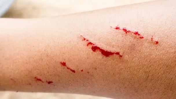Rabia humana en Zacatecas joven atacada por zorrillo