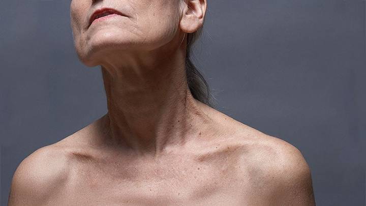 FDA Panel Seeks More Data on Filler Use in Decolletage Area
