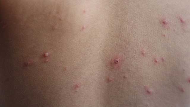 New Mexico reports 100 measles cases amid outbreak