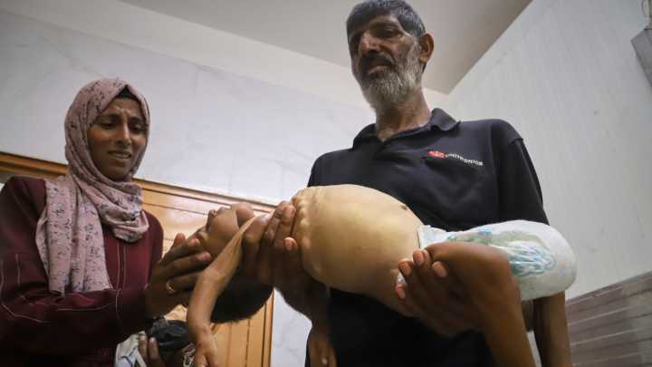Malnourished kids arrive daily at a Gaza hospital as Netanyahu denies hunger