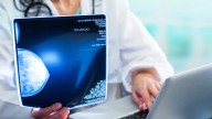 La diabetes tipo 2 impulsa la agresividad del cáncer de mama