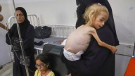 Doctors in Gaza say patients' protruding ribs, bony limbs evidence of malnutrition